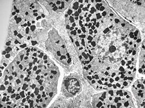 M,47y. | plasmocytoma - nasopharynx